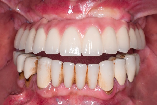 Common Cosmetic Reasons For Full Mouth Reconstruction